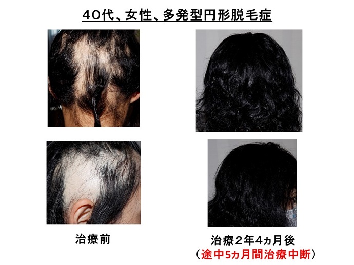 円形脱毛症　病院